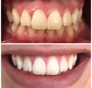 Resultado clareamento curso